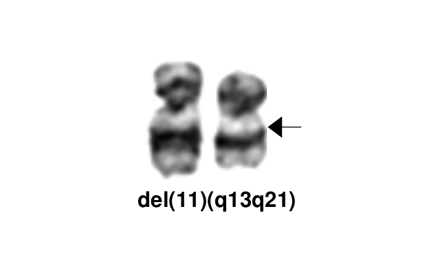 del(11)(q13q21)