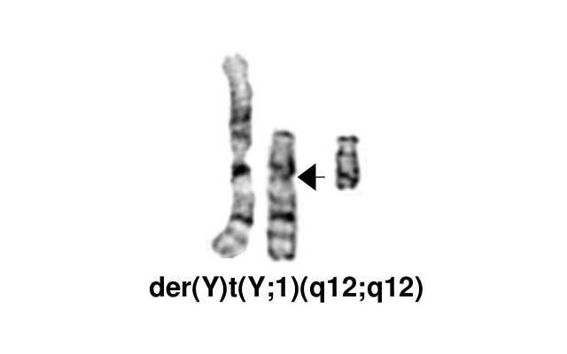 der(Y)t(Y;1)(q12;q12)