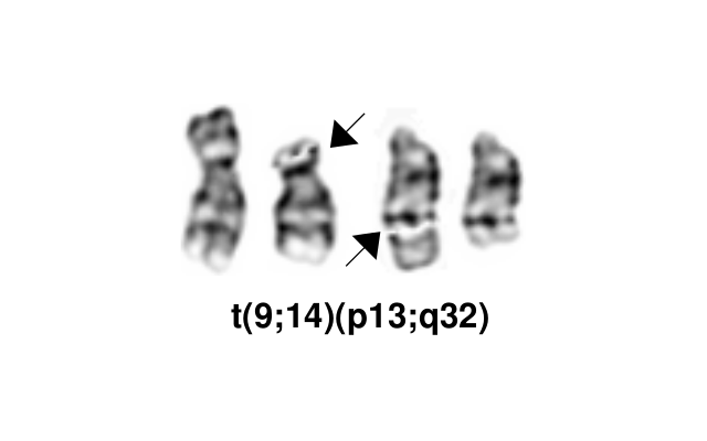 t(9;14)(p13;q32)