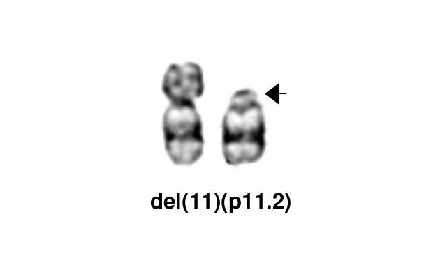del(11)(p11.2)