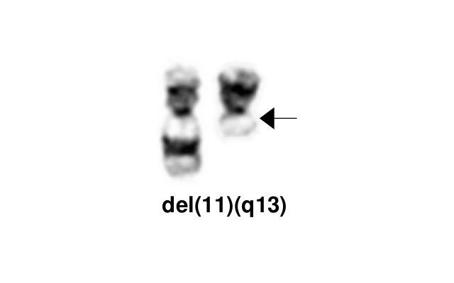del(11)(q13)