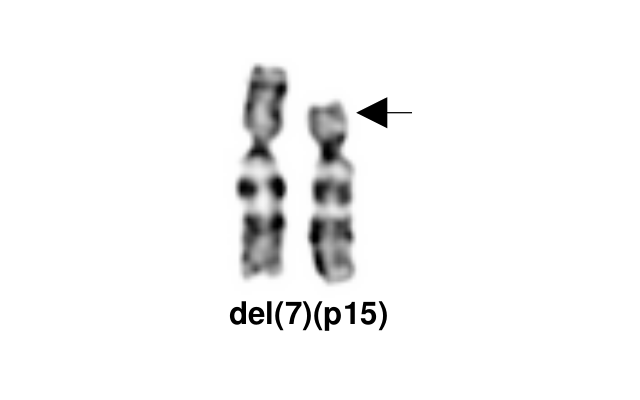 del(7)(p15)