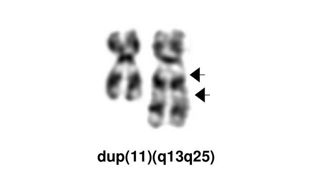 dup(11)(q13q25)