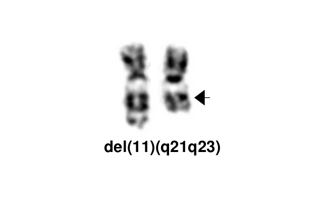 del(11)(q21q23)