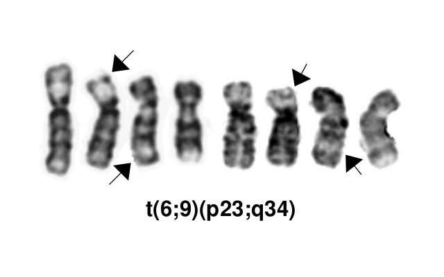 T(6;9)(p23;q34).png