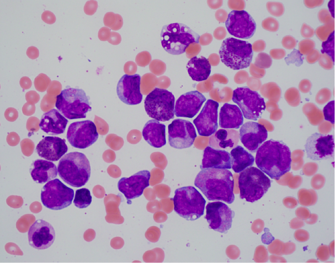 Inv 16 pathology.png