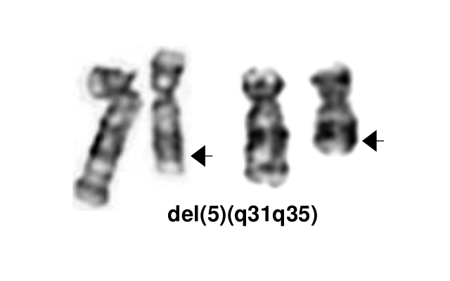 del(5)(q31q35)