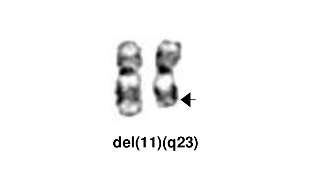 del(11)(q23)