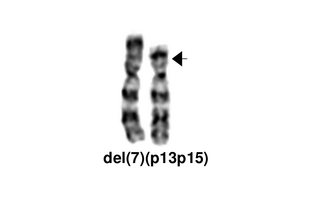 del(7)(p13p15)