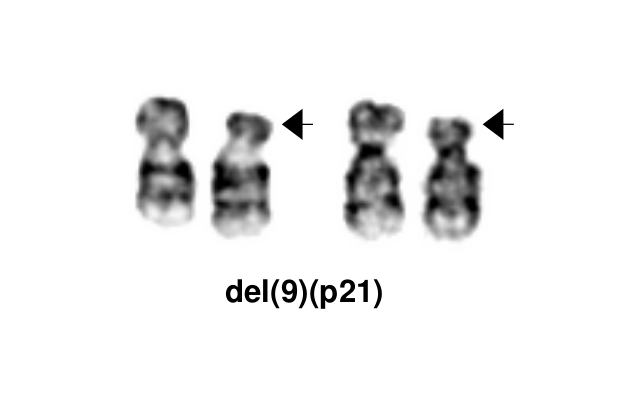 del(9)(p21)