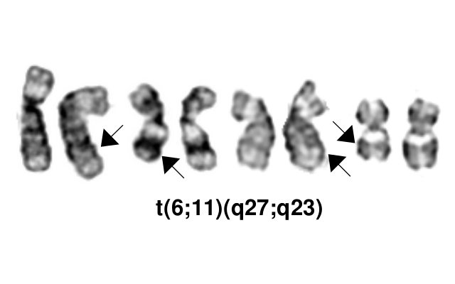 t(6;11)(q27;q23)