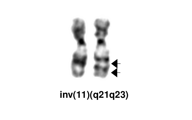 inv(11)(q21q23)