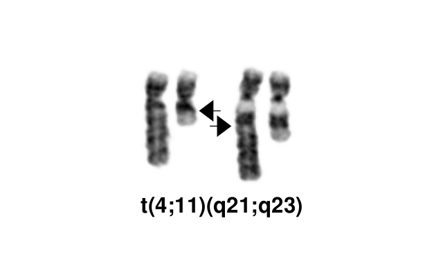 t(4;11)(q21;q23)