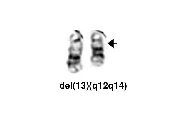 del(13)(q12q14)