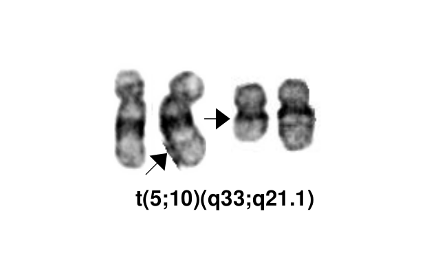t(5;10)(q33;q21.1)