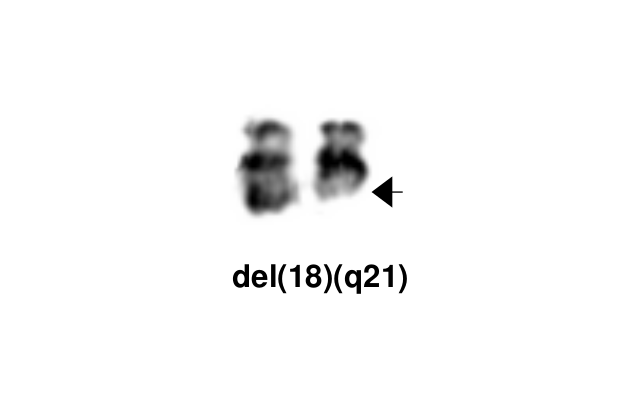 del(18)(q21)