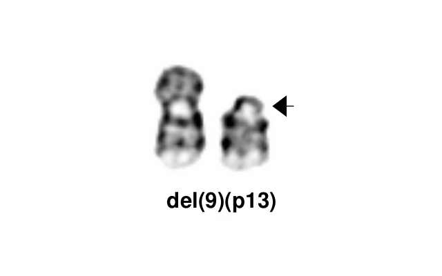 del(9)(p13)