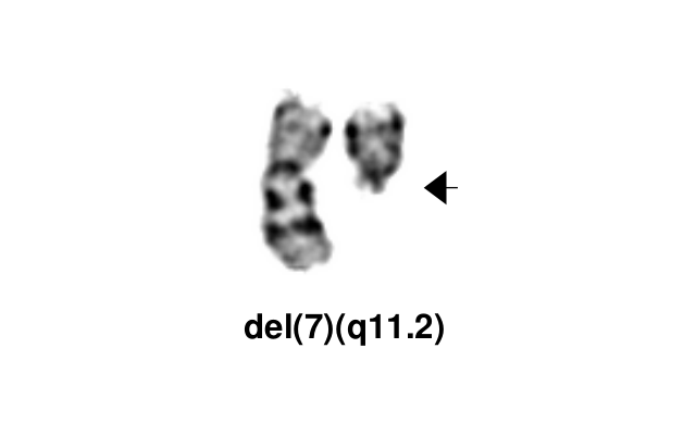 del(7)(q11.2)