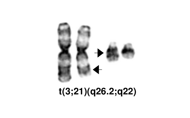 t(3;21)(q26.2;q22)