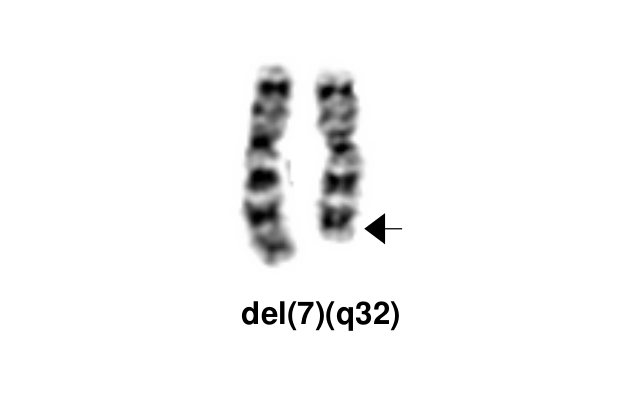 del(7)(q32)