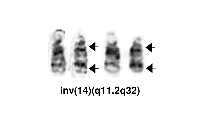 inv(14)(q11.2q32)