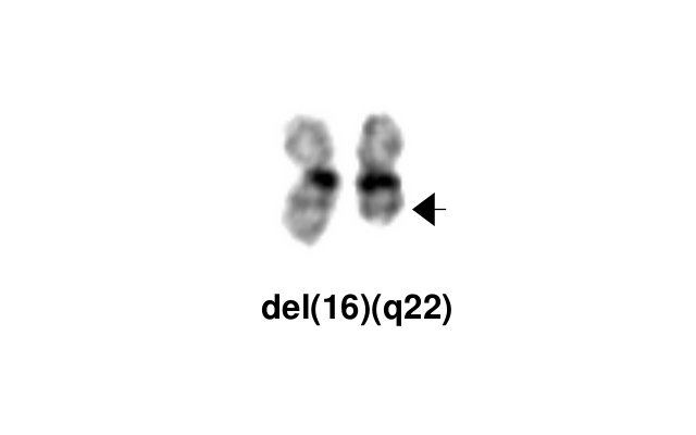 del(16)(q22)