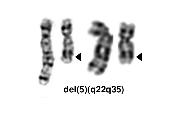 del(5)(q22q35)