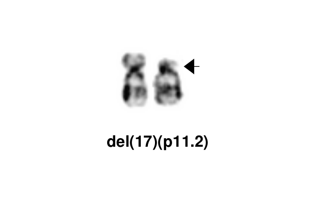 del(17)(p11.2)