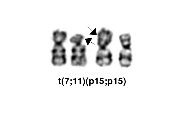 t(7;11)(p15;p15)