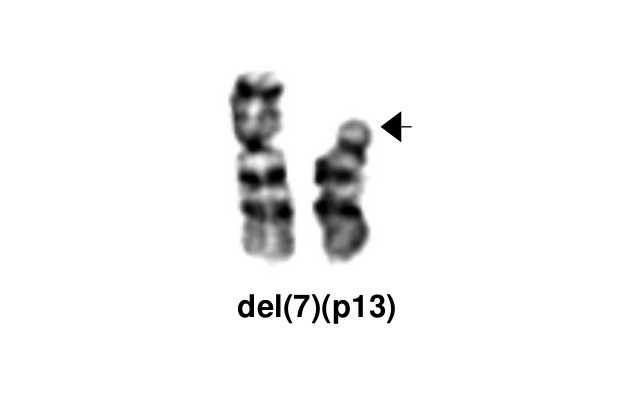 del(7)(p13)