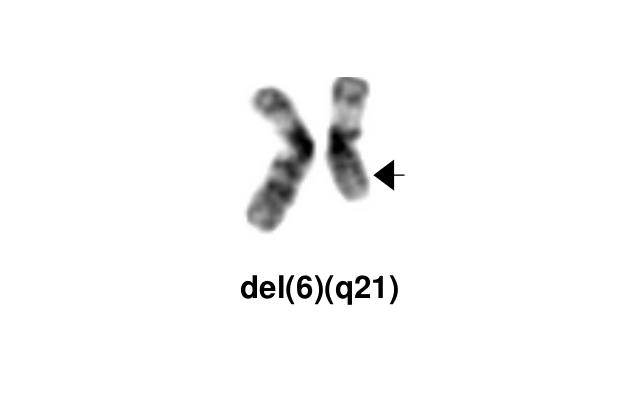 del(6)(q21)