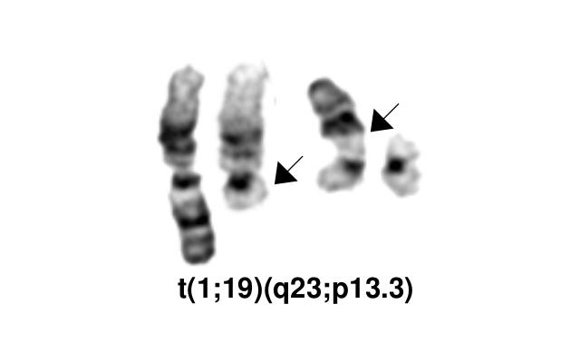 t(1;19)(q23;p13.3)