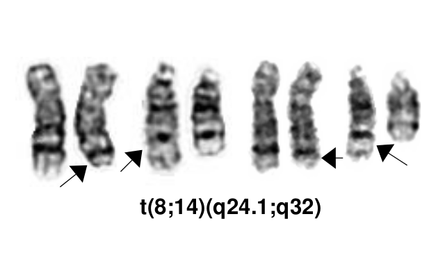 t(8;14)(q24.1;q32)